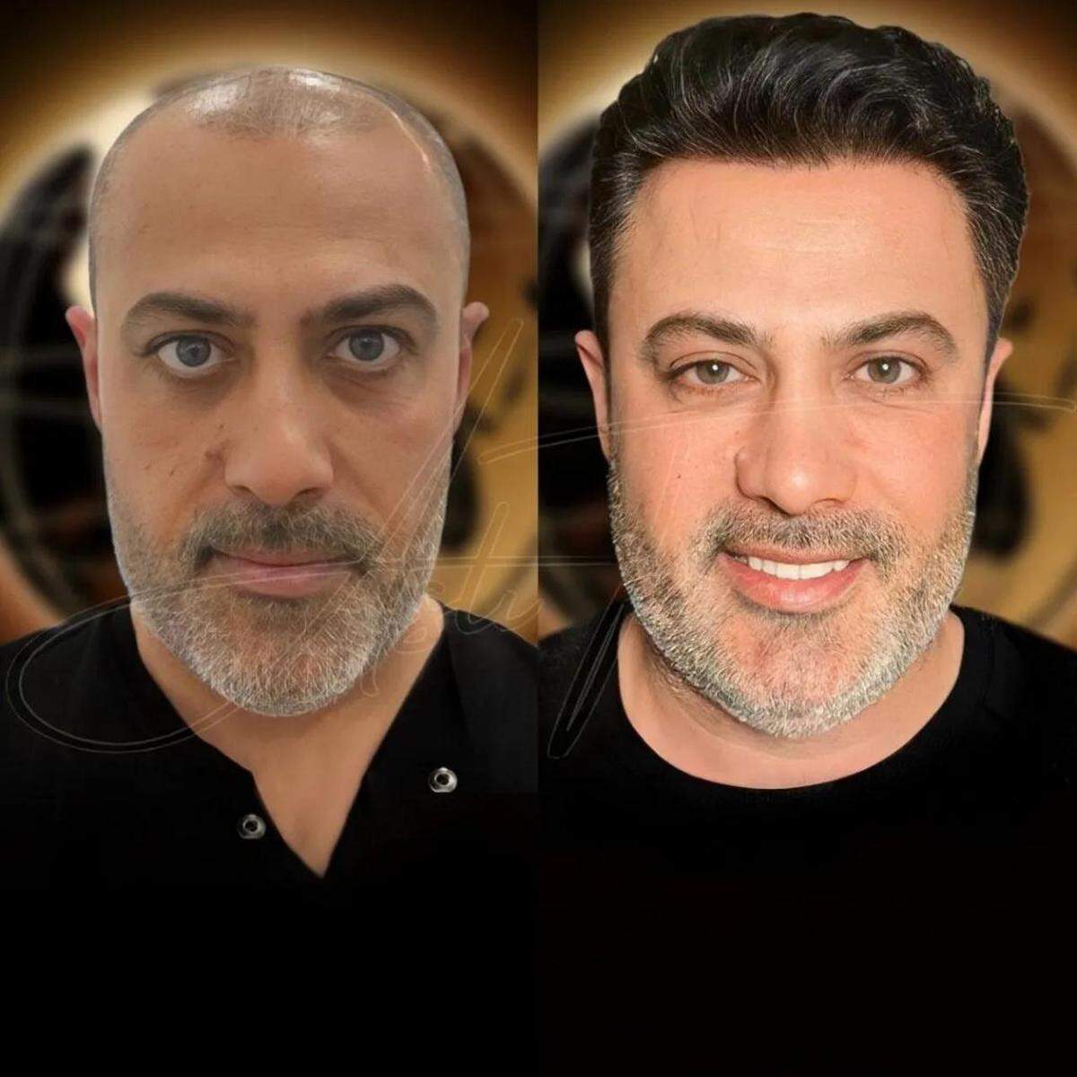 Turkey hair transplants