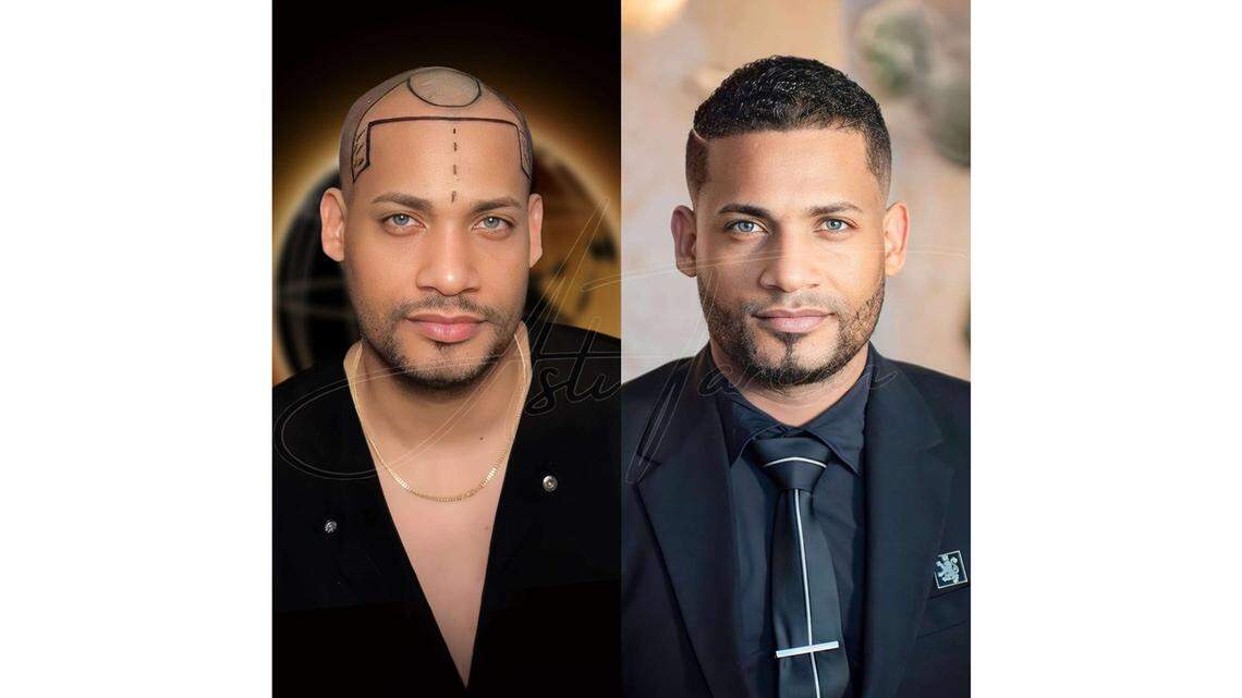 Hair Transplants in Turkey Before and After: Great Results