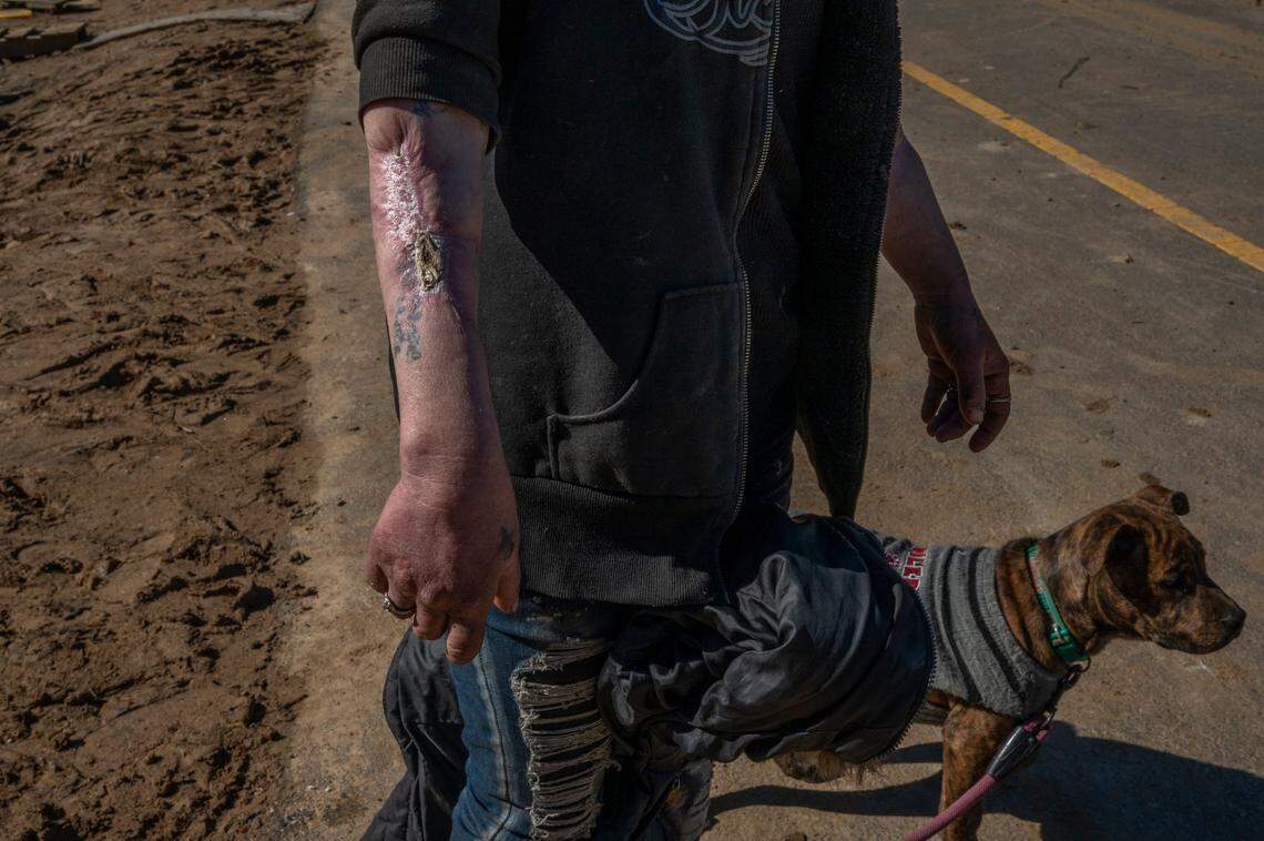 Michelle Sandbridge, whose arms were mauled in a pit bull attack, waits with her dog for a hotel voucher on Thursday while on the brink of eviction at the Bannon Island homeless encampment.
