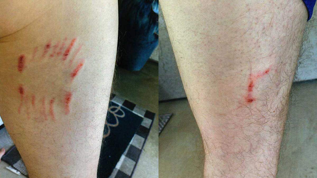 Injuries to a leg are seen on an unnamed person who was bitten by Zeus, a German shepherd puppy, in May in Elk Grove, as provided by the city of Elk Grove. The city has asked a federal judge to allow animal services to put down the dog, which they describe as dangerous.