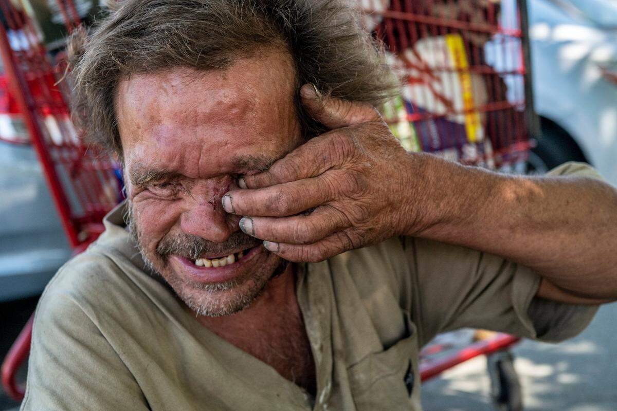 Mark Rippee rubs his eye socket where his eye is no longer visible while complaining that it’s gone but he can still feel something inside. He became blind at age 24, after a motorcycle accident that also caused a serious head injury.