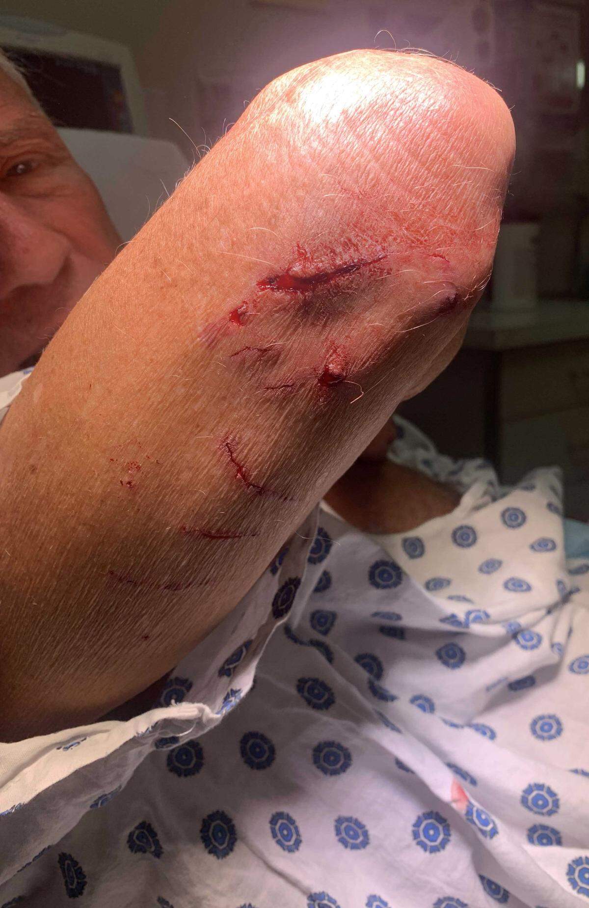 Matt Leffers shows off injuries he received after being bitten by river otters in Serene Lakes, near Lake Tahoe, this summer. State wildlife officials say humans and pets should steer clear of waterways when otters are present.