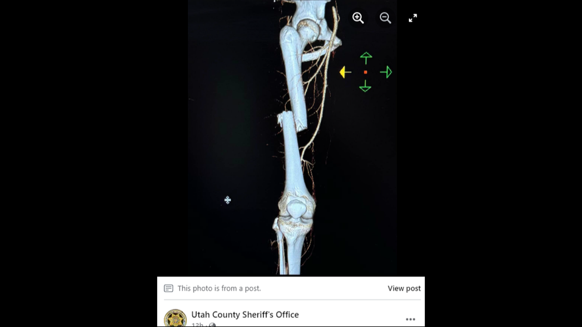 This image provided by officials shows the severity of the teen’s injury.