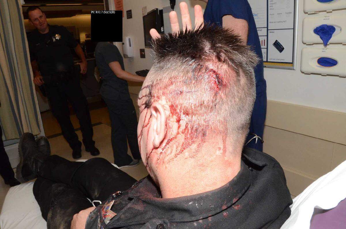 A stitched head wound is photographed on Sacramento County Sheriff’s Deputy Jeff Wright after he was hit by a rock thrown by Mikel McIntyre on May 8, 2017. Three years after McIntyre’s shooting death by deputies, Sheriff Scott Jones released videos and documents related to the case.