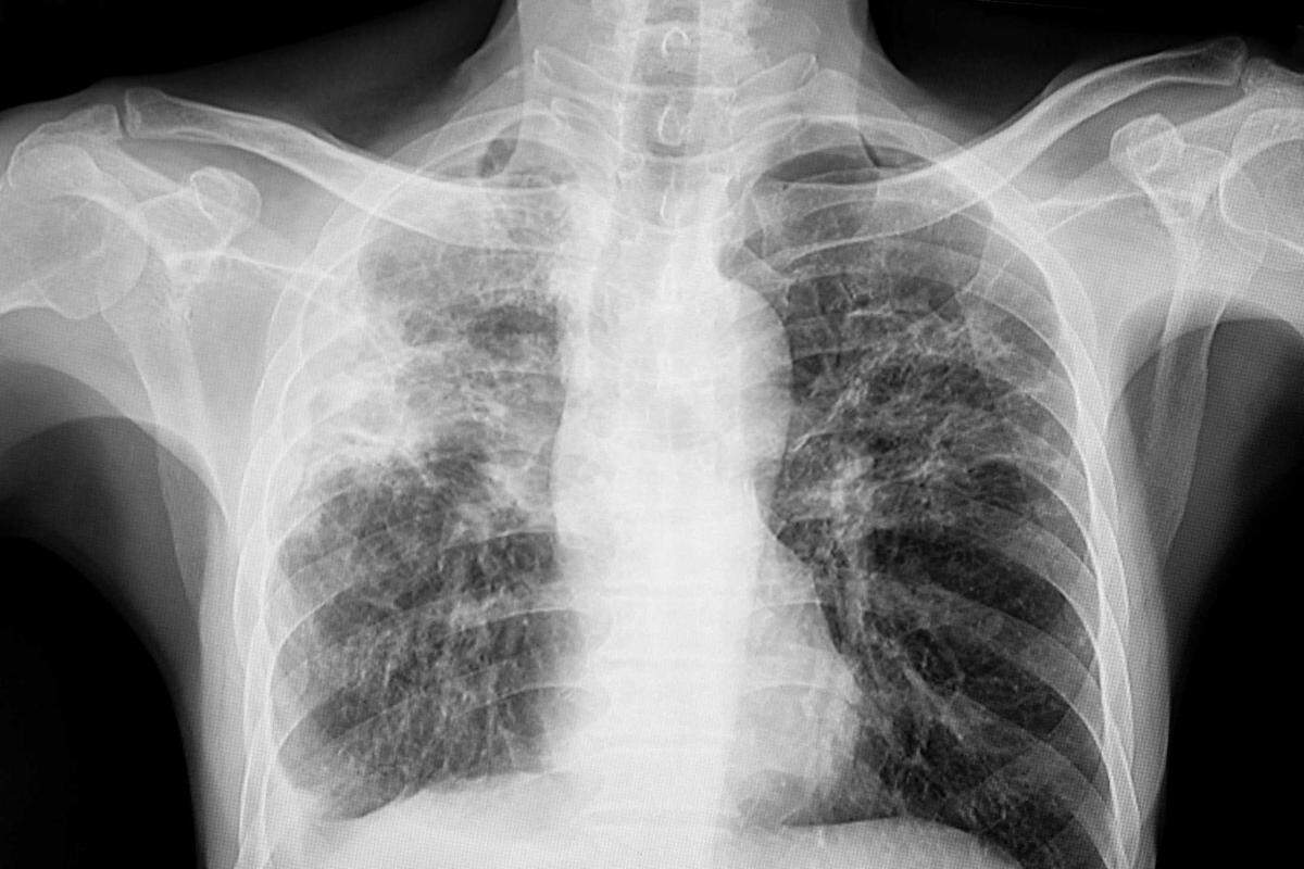 An X-ray shows the lungs of a tuberculosis patient in an undated photo. UC Davis officials said Thursday that they are monitoring an active TB case on campus and have notified individuals who had close contact with the infected person between mid-October and mid-November.