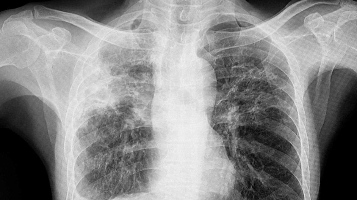 Sacramento County health officials said Thursday a Monterey Trail High School student was diagnosed with active tuberculosis and was isolating.