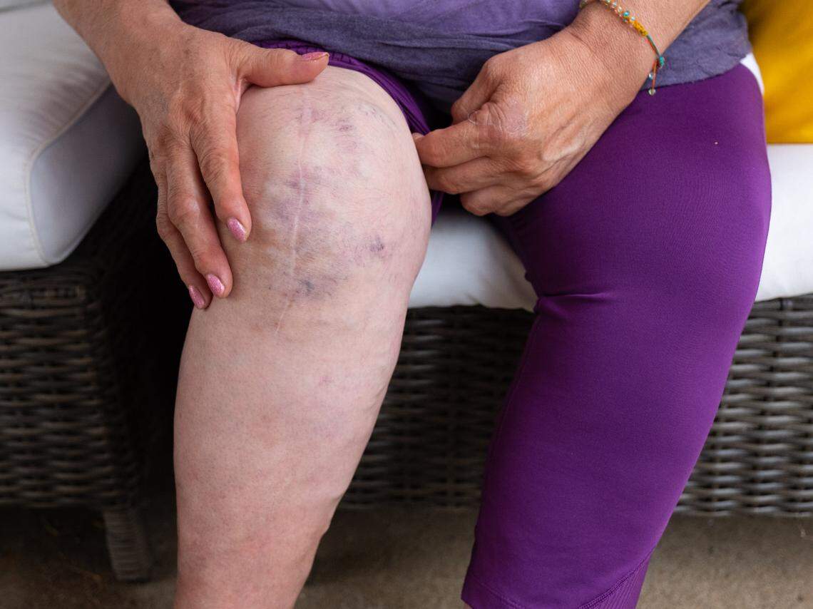 Leticia is an uninsured, undocumented California resident who received help with a knee surgery through SPIRIT, a Sierra Sacramento Valley Medical Society program.