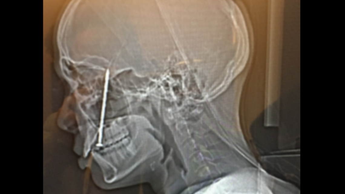 A CT scan of Timothy Kahae’s skull on Nov. 15, 2021, shows the nail in his head, according to the lawsuit.