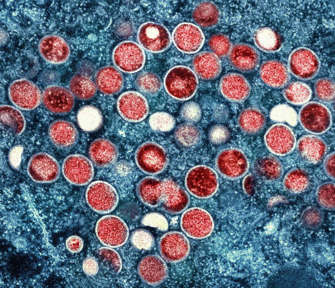 This image provided by the National Institute of Allergy and Infectious Diseases shows a colorized transmission electron micrograph of monkeypox particles (red) found within an infected cell (blue), cultured in the laboratory that was captured and color-enhanced at the NIAID Integrated Research Facility in Fort Detrick, Md.