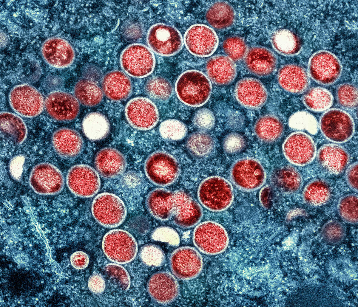 This image provided by the National Institute of Allergy and Infectious Diseases shows a colorized transmission electron micrograph of monkeypox particles (red) found within an infected cell (blue), cultured in the laboratory that was captured and color-enhanced at the NIAID Integrated Research Facility in Fort Detrick, Md.