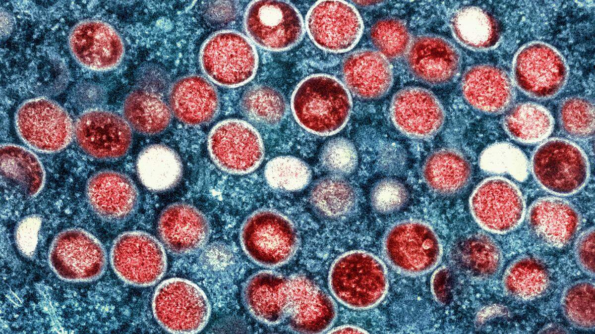 The first confirmed death due to monkeypox was reported in Los Angeles County, public health officials say. The CDC helped confirm the cause of death.