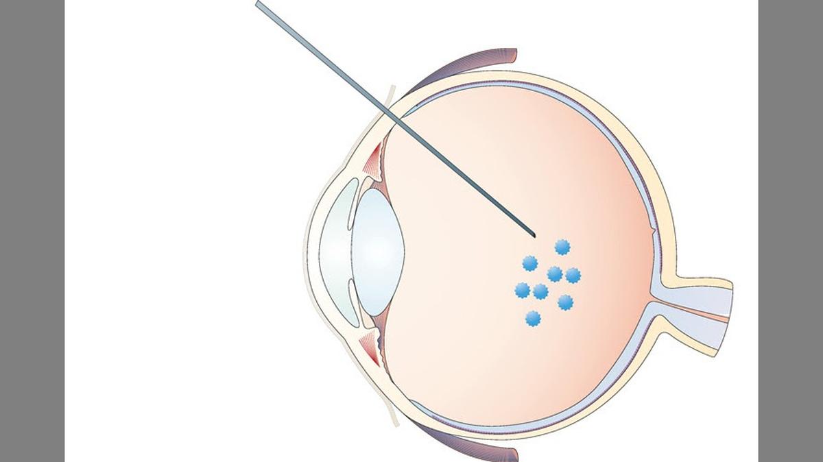 New therapy for blindness involves injecting inactivated viruses into the eye that carry a gene to replace lost light detectors.