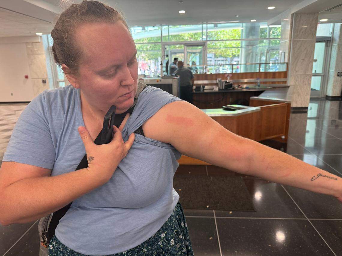 Frankie Irvine, of Roseville, shows off some of the injuries she sustained while attempting to escort an immigrant out of a court hearing at the John E. Moss Federal Building on Friday, June 20, 2025. Irvine and another advocate volunteer with NorCal Resist were forcibly separated from the young man, and thrown into the wall and ground by plainclothed Immigrations and Customs Enforcement officers who refused to identify themselves or provide a warrant for the man’s detention.
