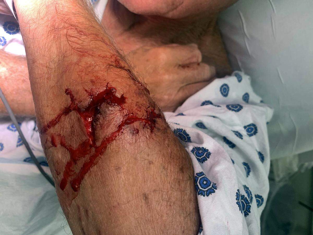 Matt Leffers shows off injuries he received after being bitten by river otters in Serene Lakes, near Lake Tahoe, this summer. State wildlife officials say humans and pets should steer clear of waterways when otters are present.