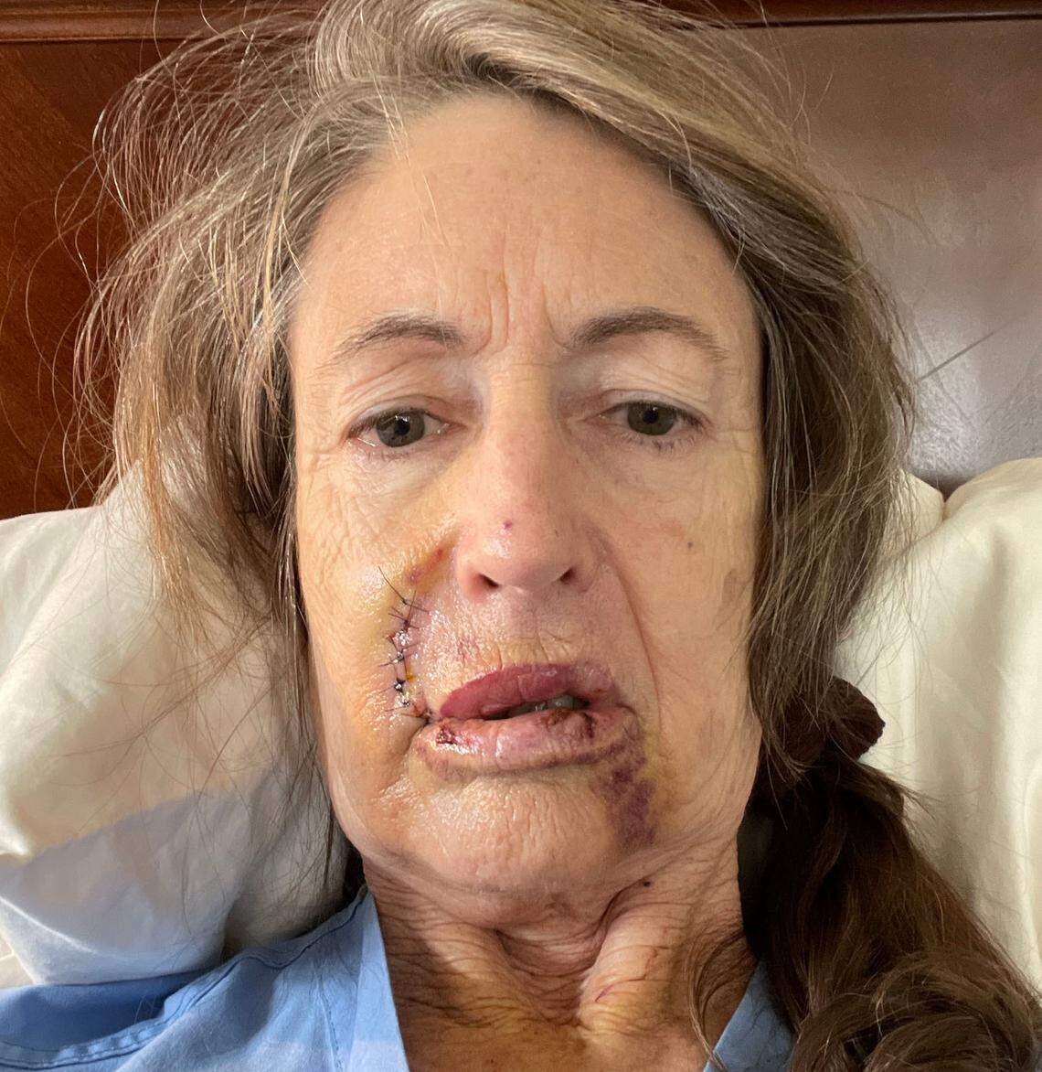 Laurel-Rose Von Hoffmann-Curzi shortly after being attacked by a bear in her Tahoe Vista cabin in late October.