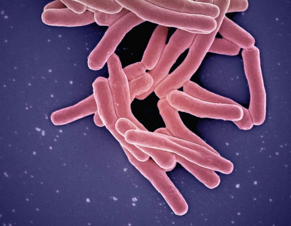 After being dormant in the body for years, Mycobacterium Tuberculosis can suddenly multiply and cause an active TB infection.