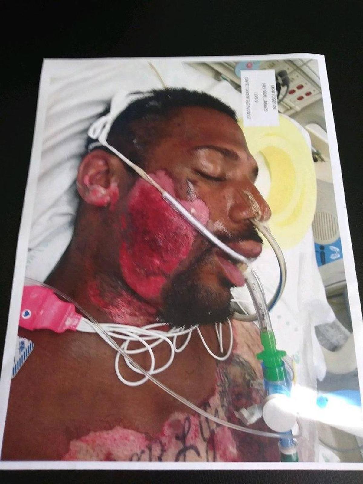 A photo of a hospital photograph shows the burns on James Nelson’s face and chest. The injuries occurred June 23, 2017 in a KFC parking lot when Citrus Heights police officers held him on the hot pavement after receiving calls that he was acting erratically.