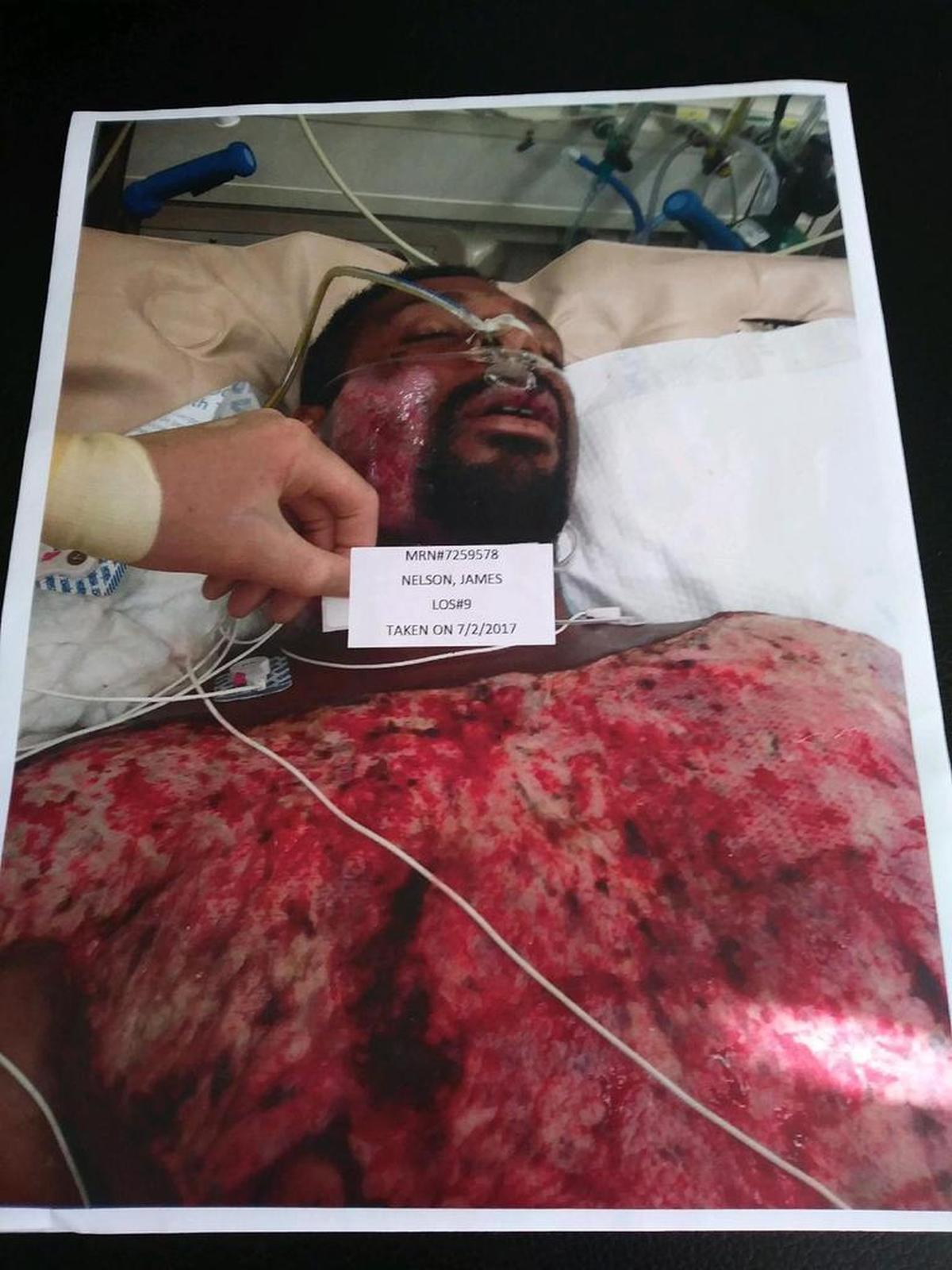 A photo of a hospital photograph shows the burns on James Nelson’s face and chest. The injuries occurred June 23, 2017 in a KFC parking lot when Citrus Heights police officers held him on the hot pavement after receiving calls that he was acting erratically.
