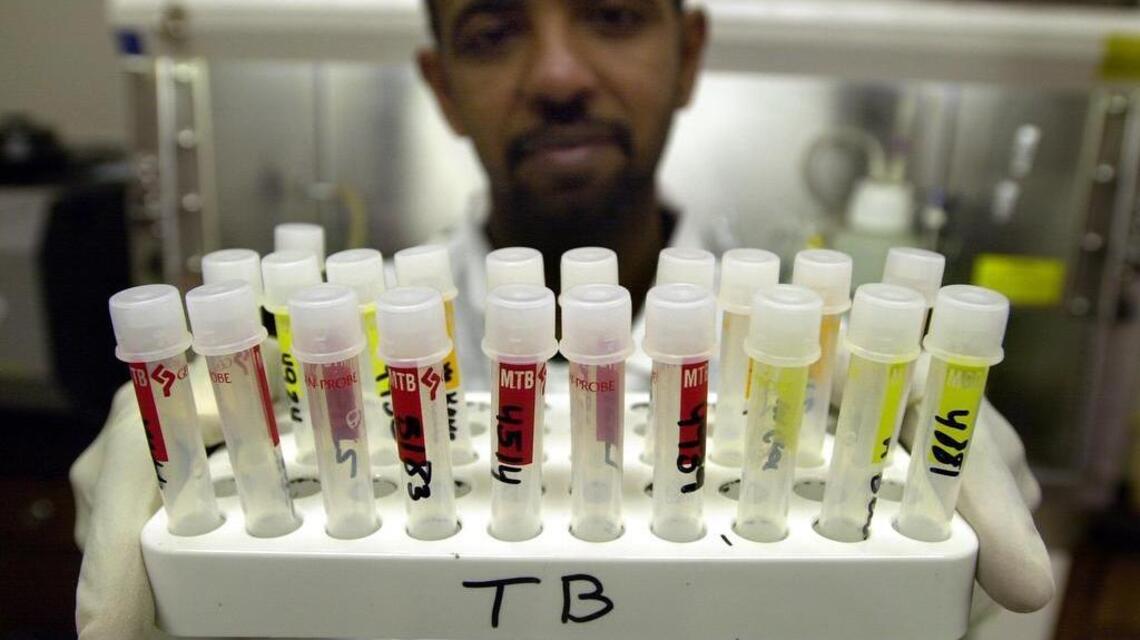 Stanislaus County health officials stress early detection for tuberculosis for those at risk