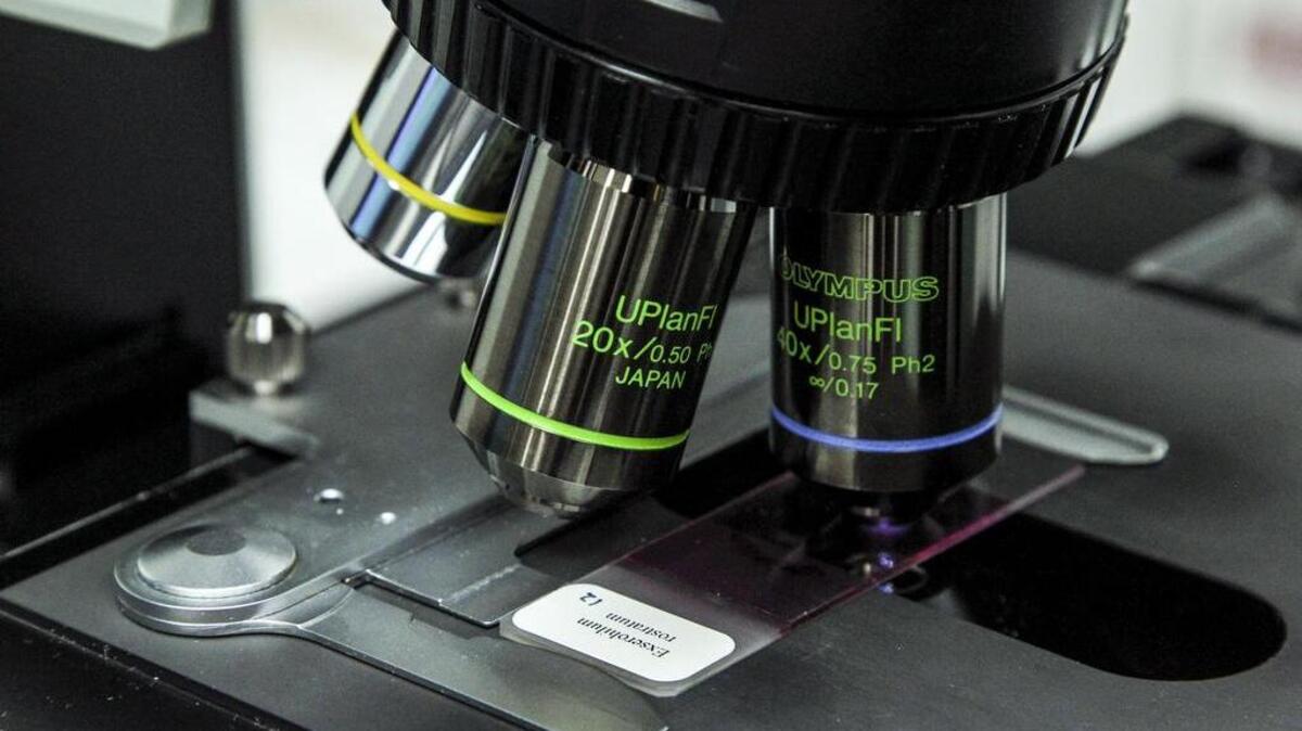 A closeup view of a microscope taking a look at a slide meningitis causing fungus Exserohilum rostratum at the Mycotic lab at the Centers for Disease Control and Prevention on Oct. 12, 2012 in Atlanta. Meningitis is a swelling of the protective membranes of the spinal cord and brain caused by an infection. Symptoms include nausea, fever, stiff neck, vomiting and sensitivity to light. The CDC’s website says the illness is “very serious and can be deadly.” The bacteria is spread through airborne droplets.