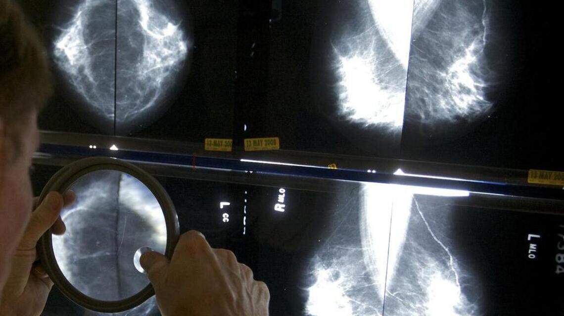 Mammograms at 45: American Cancer Society changes breast cancer guidelines