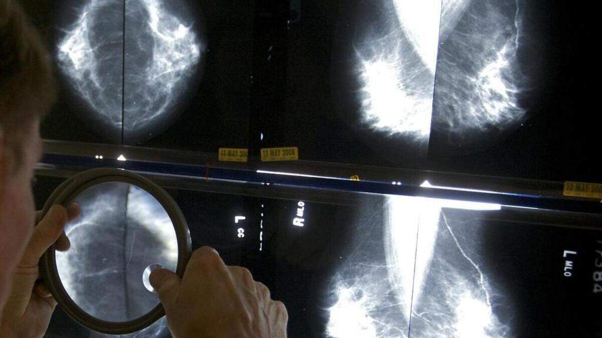 A radiologist uses a magnifying glass to check mammograms for breast cancer in Los Angeles.