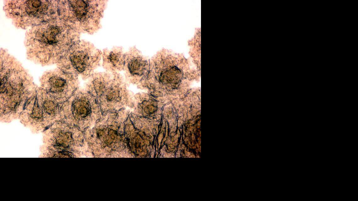 Tuberculosis cases on the rise in SLO County, health department warns. What to know