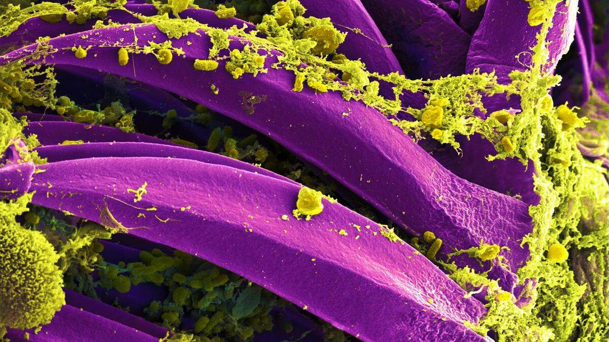 Microscopic photos shoe the Yersinia pestis bacterium, in yellow, which causes bubonic plague.