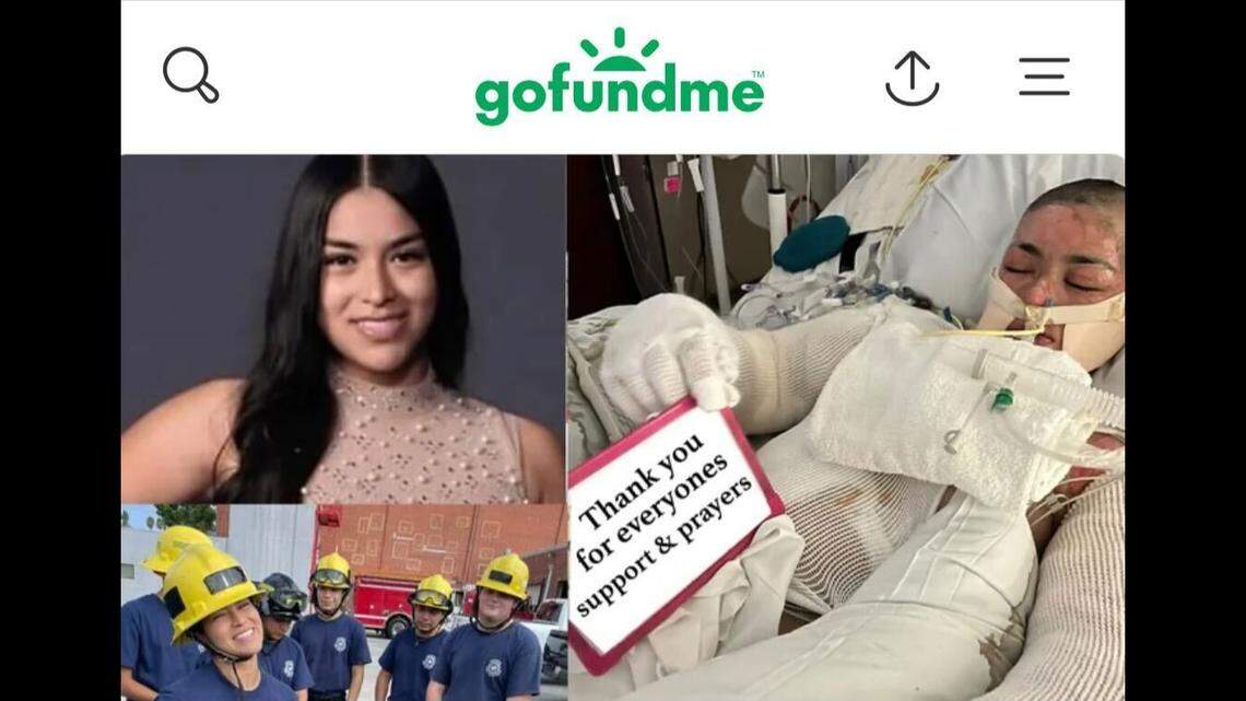 America Salmeron, 17, suffered second and third degree burns after pulling herself out of a fiery dune buggy after it flipped, California officials said.