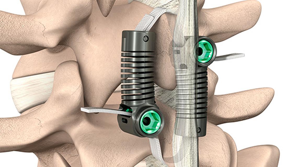 Empirical Spine Announces First Commercial LimiFlex(R) Cases at Stanford Medicine, Marking U.S. Launch of Motion-Preserving Alternative to Fusion for Degenerative Spondylolisthesis 