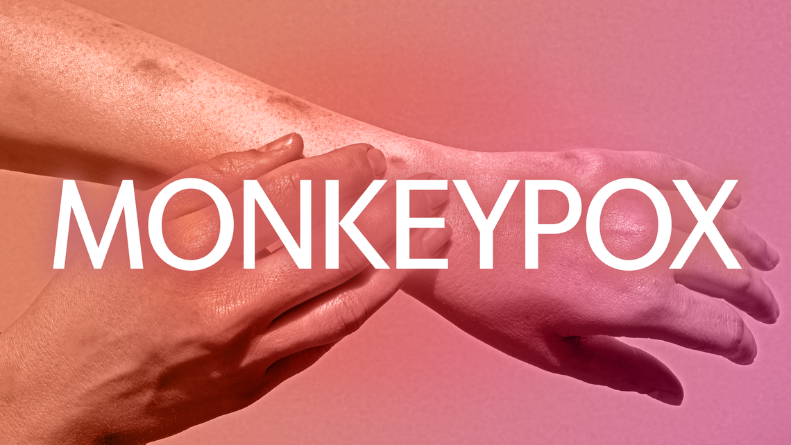 Monkeypox: Hand with visible monkeypox lesions